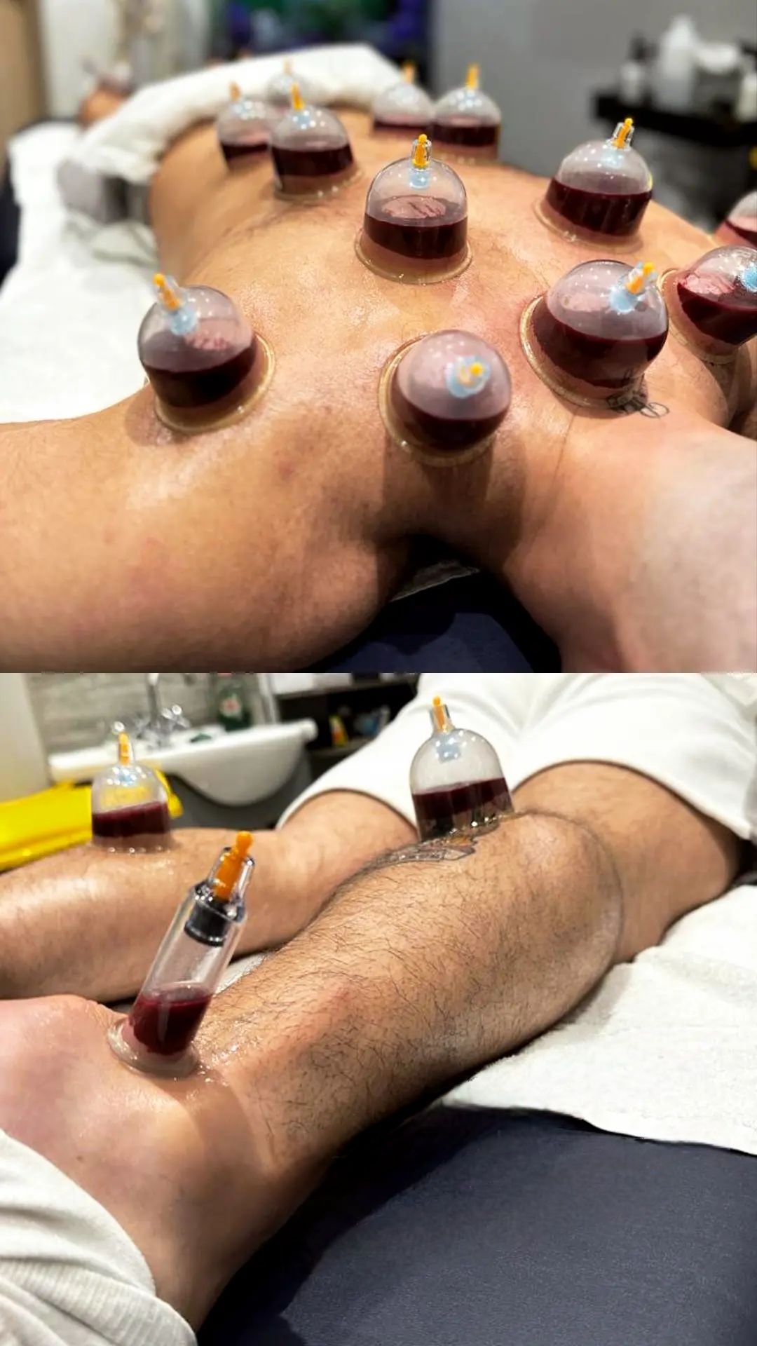 Arthritis cure arthritis in feet treatment arthritis in hands treatment arthritis in hindi treatment arthritis joint pain treatment arthritis rheumatoid treatment arthritis treatment in hyderabad arthritis treatment knee pain best arthritis treatment in hyderabad best doctor for rheumatoid arthritis in hyderabad best rheumatoid arthritis doctor in hyderabad best rheumatoid arthritis treatment cupping knee arthritis cupping therapy for arthritis cupping therapy for arthritis treatment cupping therapy rheumatoid arthritis cupping treatment for arthritis hand arthritis treatment in hyderabad hijama cupping for arthritis knee arthritis cupping knee arthritis treatment without surgery latest treatment for rheumatoid arthritis natural treatment arthritis rheumatoid arthritis best doctors in hyderabad rheumatoid arthritis best treatment in india rheumatoid arthritis doctor in hyderabad rheumatoid arthritis muscle pain treatment rheumatoid arthritis natural cure rheumatoid arthritis natural treatment rheumatoid arthritis new treatment rheumatoid arthritis pain treatment rheumatoid arthritis permanent treatment rheumatoid arthritis specialist in hyderabad rheumatoid arthritis symptoms and treatment rheumatoid arthritis treatment for fingers rheumatoid arthritis treatment hindi rheumatoid arthritis treatment in hyderabad tm joint arthritis treatment treatment for acute gouty arthritis treatment for arthritis of the knee treatment for foot arthritis treatment for psoriasis arthritis treatment for rheumatoid arthritis in fingers treatment for rheumatoid arthritis of the knee treatment for seronegative arthritis treatment of ankle arthritis treatment of gout arthritis treatment of tmj arthritis what is the latest treatment for rheumatoid arthritis what is the treatment of rheumatoid arthritis what is treatment for rheumatoid arthritis which treatment is best for rheumatoid arthritis